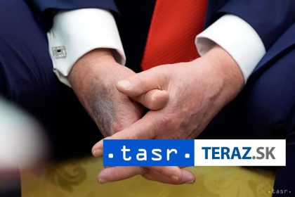 Trumpove modriny na rukach vyvolavaju obavy o zdravie